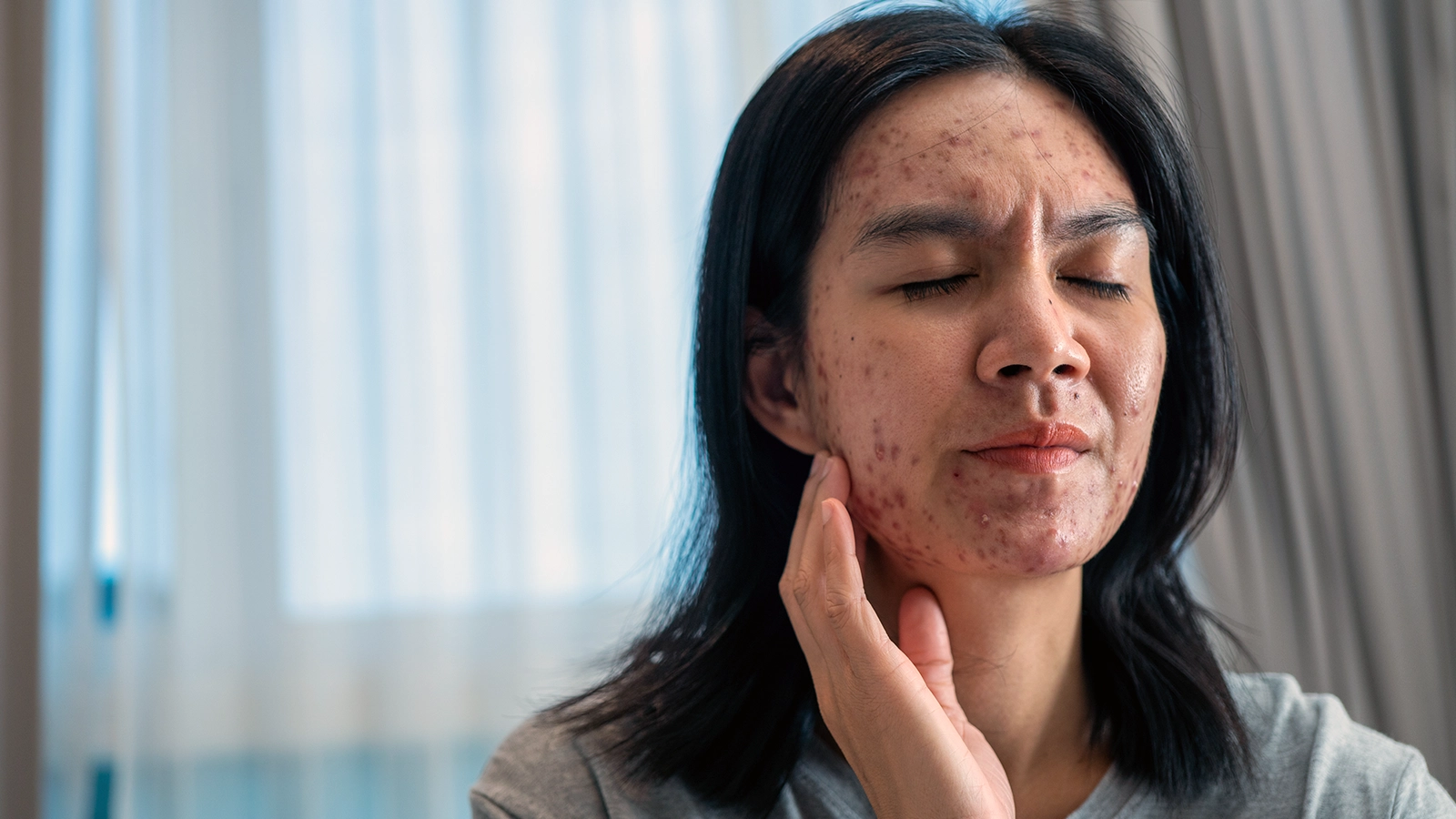 Common Skin Concerns: Acne, Pigmentation, and Aging