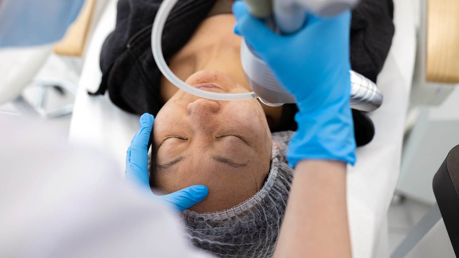 BBL Laser Treatment Overview