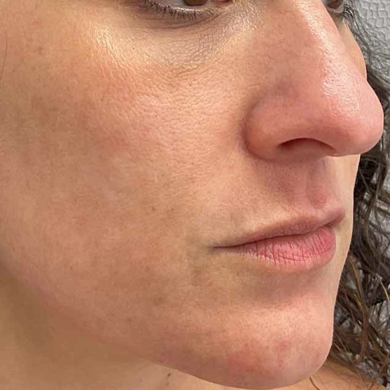 Acne Laser Treatment After Photo