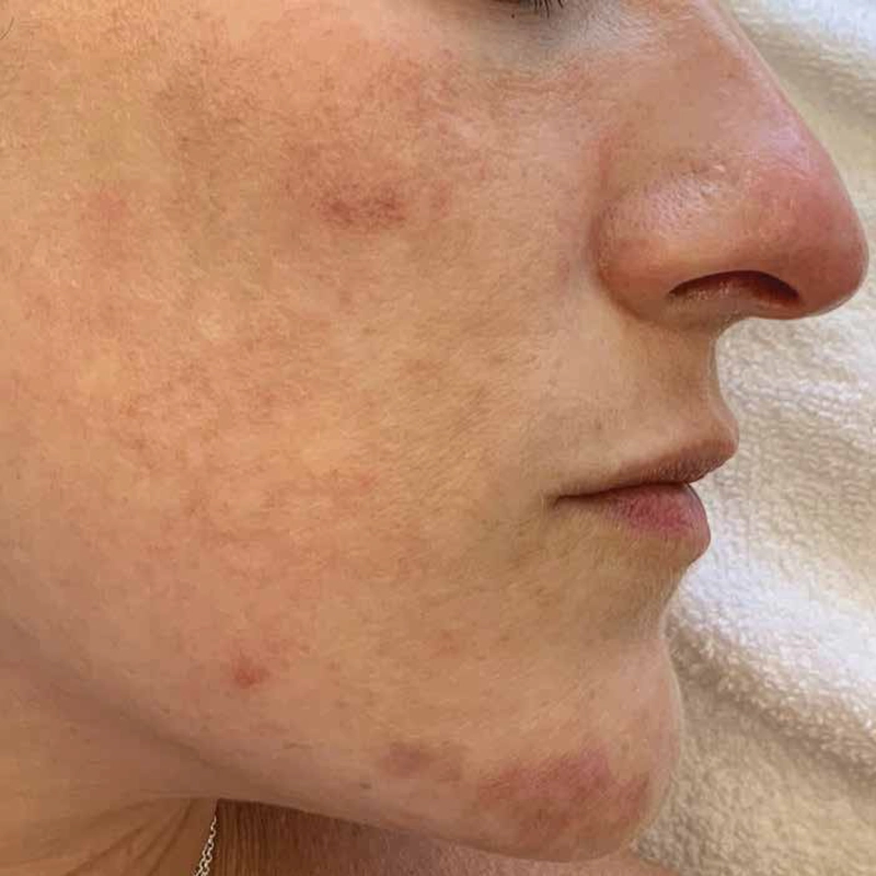 Acne Laser Treatment Before Photo