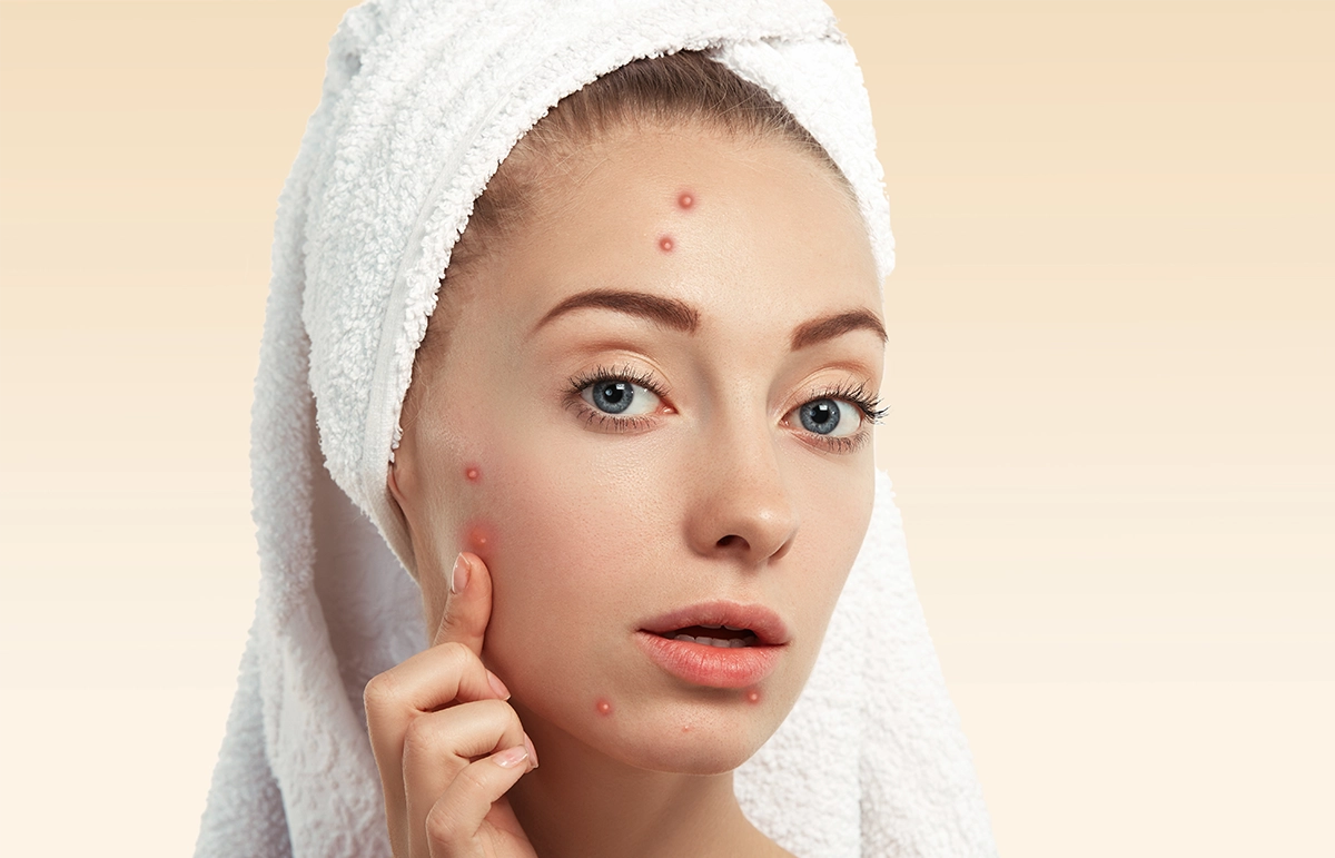 Acne Laser Treatment