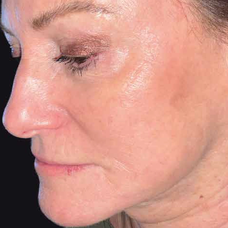 Anti-Ageing Skin Rejuvenation After Photo