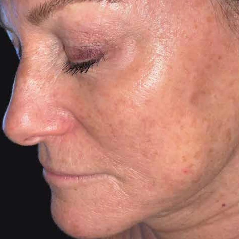 Anti-Ageing Skin Rejuvenation Before Photo
