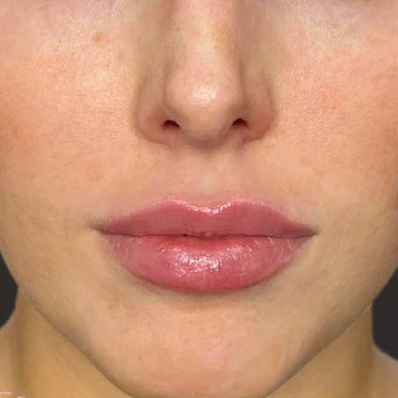 Dermal Filler After Photo