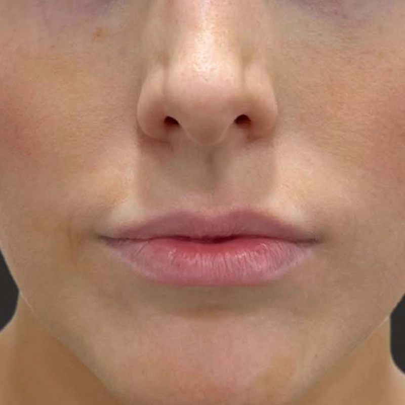 Dermal Filler Before Photo