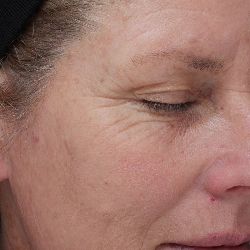 Laser Treatment for HyperPigmentation After Photo