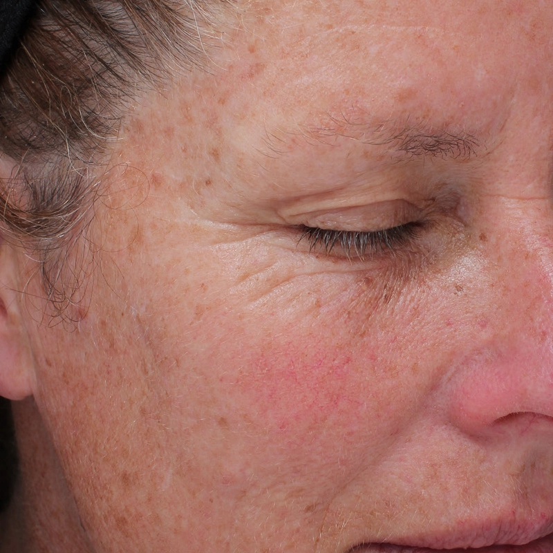 Laser Treatment for HyperPigmentation Before Photo