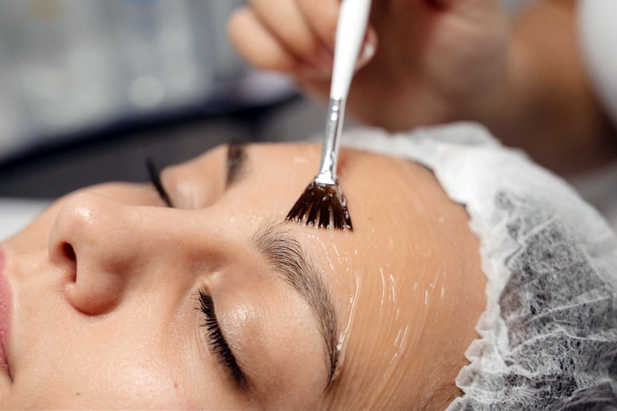 Personalized Chemical Peels