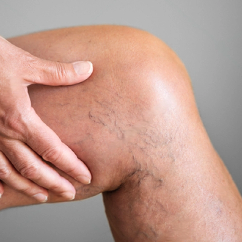 Varicose Vein Treatments Before Photo