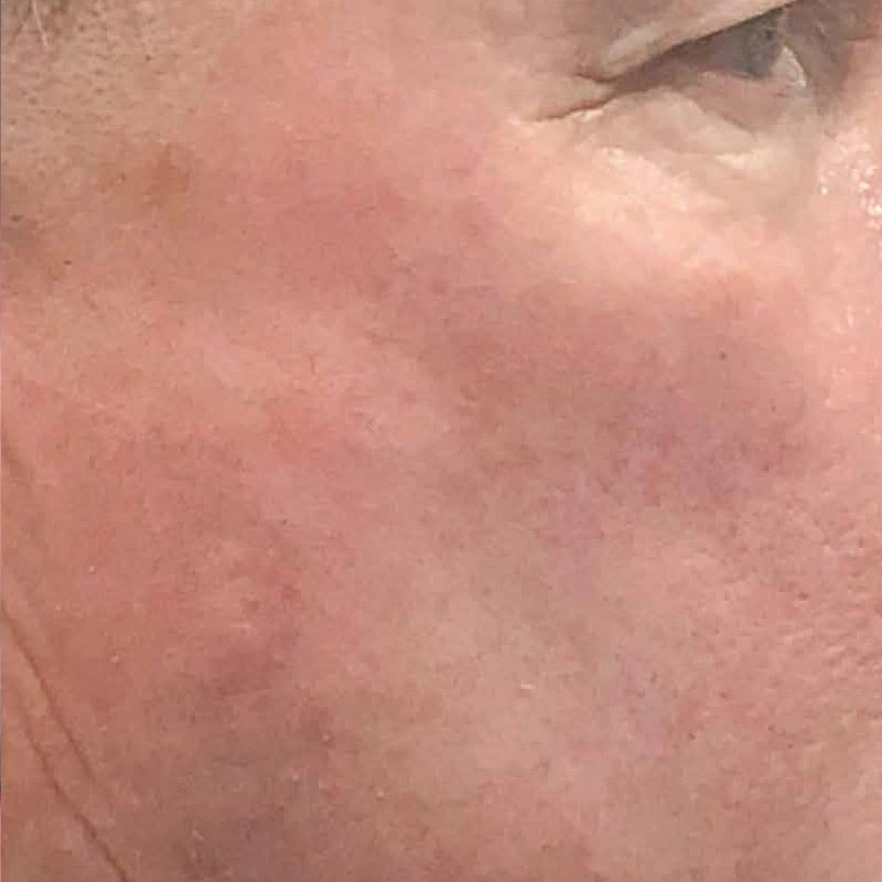 Vascular Laser Treatment After Photo