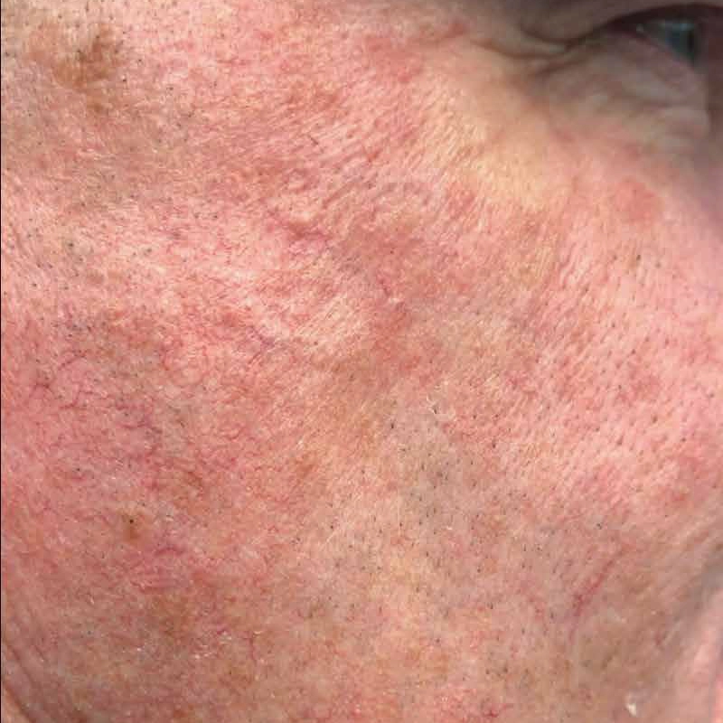 Vascular Laser Treatment Before Photo