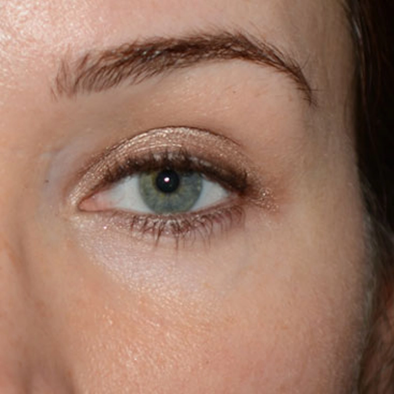 Wrinkle Relaxation After Photo
