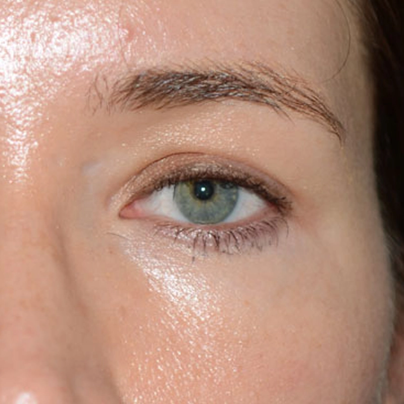 Wrinkle Relaxation Before Photo